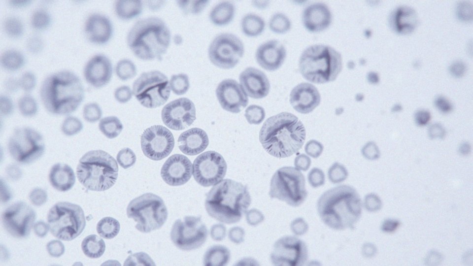 Co oznaczają cechy atypii komórek nabłonkowych?